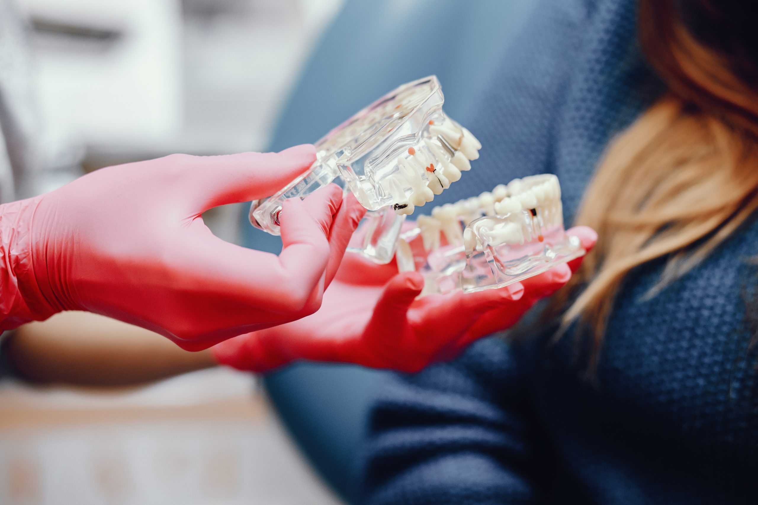 Costo impianto dentale per l’arcata superiore: guida ai prezzi e alle opzioni disponibili
